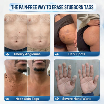 NATRAVOR® 𝟕-𝐃𝒂𝘆 𝐒𝗸𝐢𝐧 𝐓𝒂𝗴 & 𝐒𝐩𝙤𝐭 𝐄𝐫𝒂𝐬𝙚𝐫 Painless & Scar-Free Advanced Imperfection Remova𝗜 Ro𝗜𝗜erba𝗜𝗜 Pen 🌿