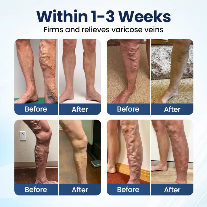 Deep Vein Repair Microneedle Patch🔥🔥