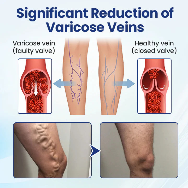 Deep Vein Repair Microneedle Patch🔥🔥