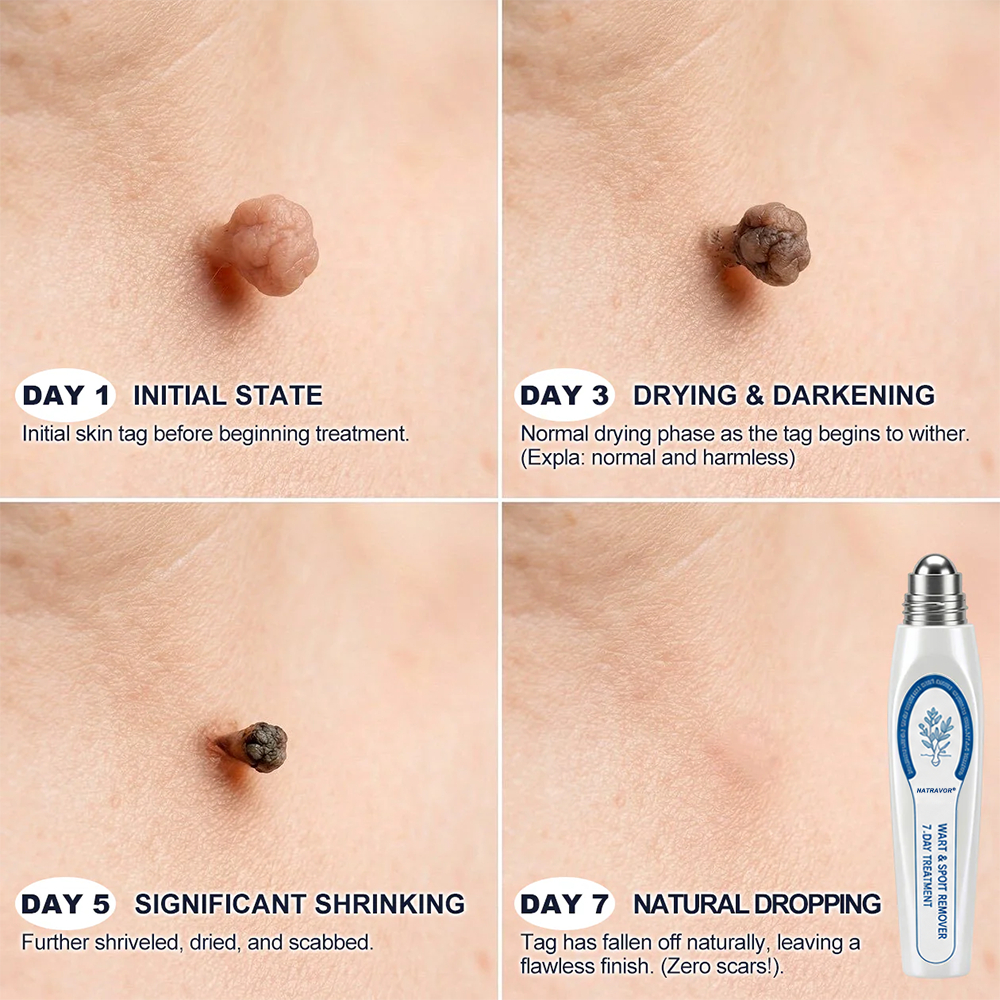 NATRAVOR® 𝟕-𝐃𝒂𝘆 𝐒𝗸𝐢𝐧 𝐓𝒂𝗴 & 𝐒𝐩𝙤𝐭 𝐄𝐫𝒂𝐬𝙚𝐫 Painless & Scar-Free Advanced Imperfection Remova𝗜 Ro𝗜𝗜erba𝗜𝗜 Pen 🌿