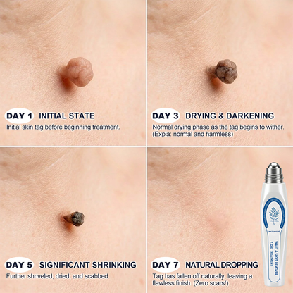 NATRAVOR® 𝟕-𝐃𝒂𝘆 𝐒𝗸𝐢𝐧 𝐓𝒂𝗴 & 𝐒𝐩𝙤𝐭 𝐄𝐫𝒂𝐬𝙚𝐫 Painless & Scar-Free Advanced Imperfection Remova𝗜 Ro𝗜𝗜erba𝗜𝗜 Pen 🌿