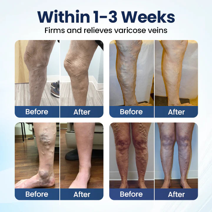 Deep Vein Repair Microneedle Patch🔥🔥