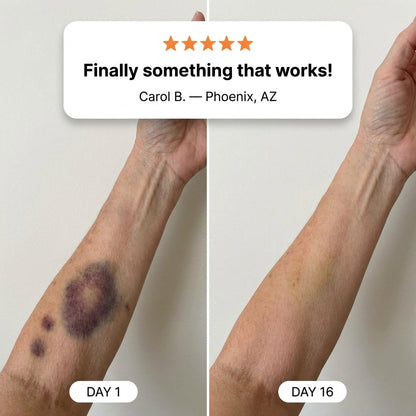 💥100K+ SOLD💕- Natrvor® Bruise Repair & Skin-Strengthening Cream